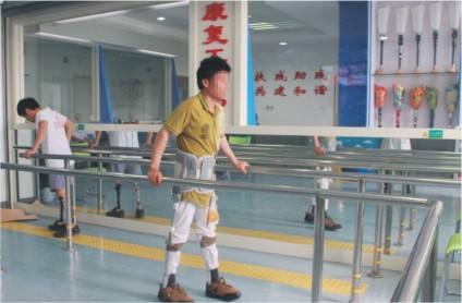 假肢怎么康復(fù)呢(圖1) 假肢怎么康復(fù)呢